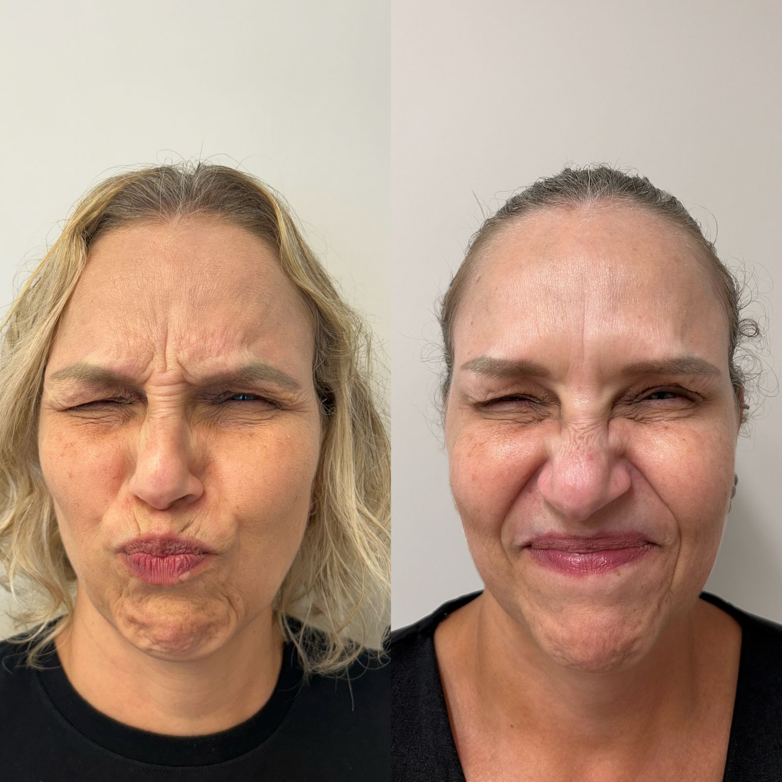 Comparativo de resultado de tratamento facial