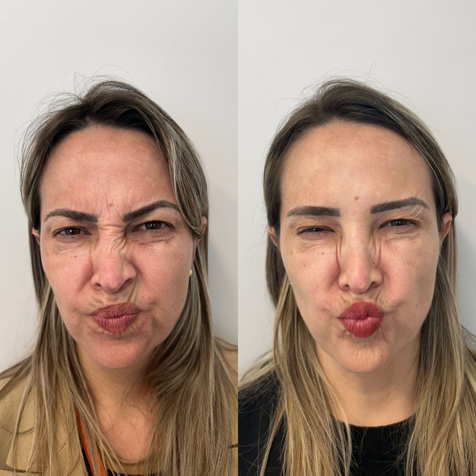 Comparativo de resultado de tratamento facial