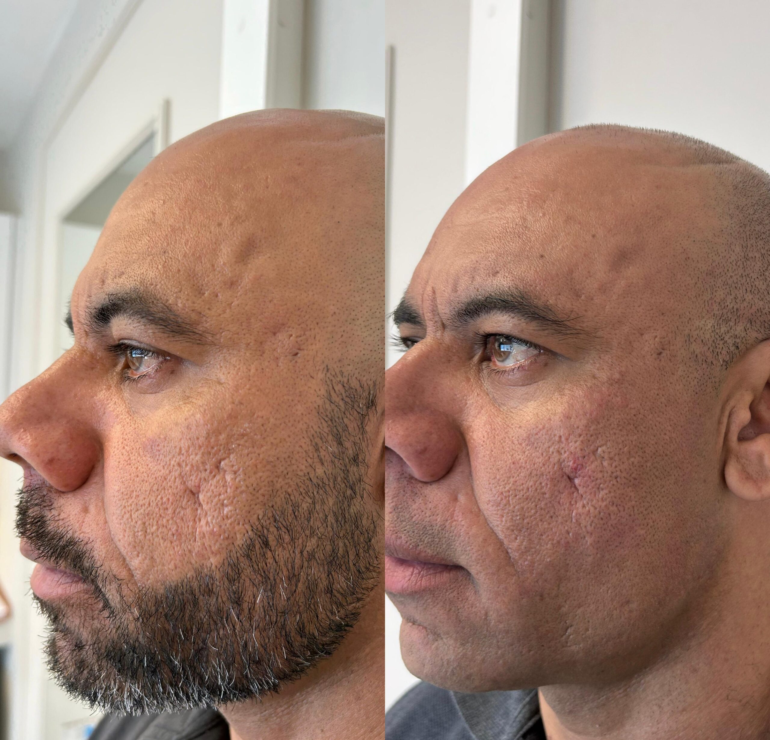 Comparativo de resultado de tratamento facial