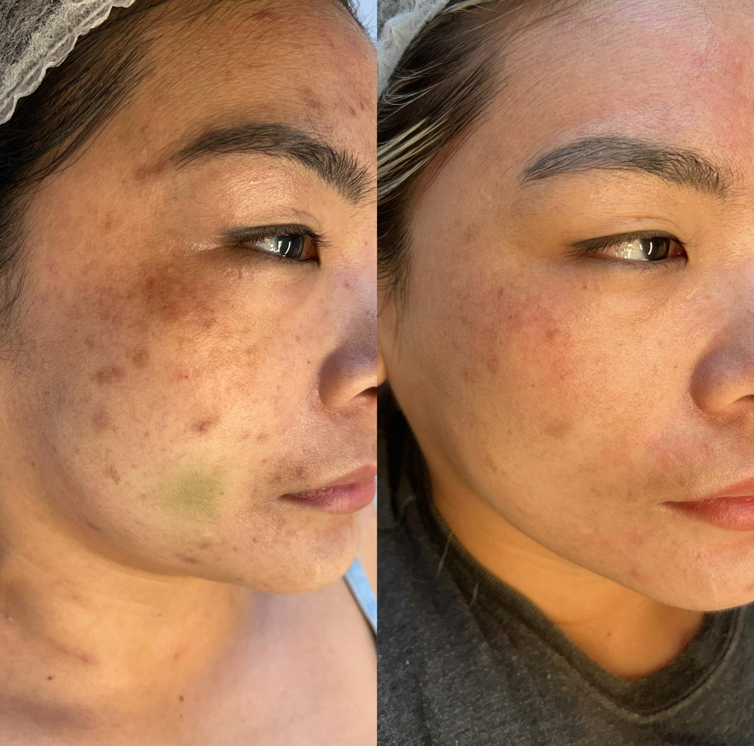 Comparativo de resultado de tratamento facial