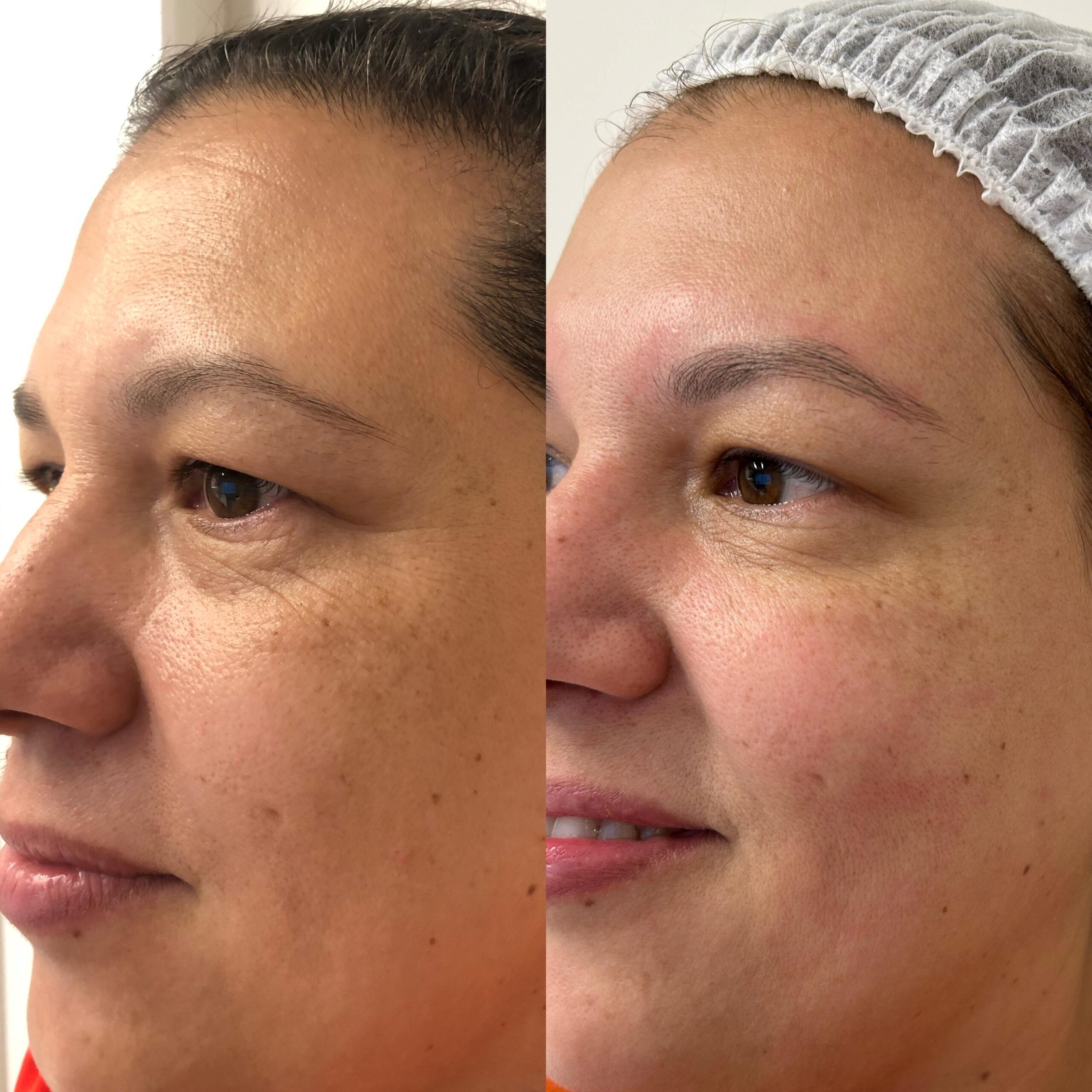 Comparativo de resultado de tratamento facial